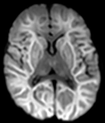 A fatal pediatric infection with a C1-like subgenogroup enterovirus A71: case study and enterovirus A71 epidemiology in Finland